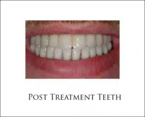 Replacing Periodontally Compromised Teeth