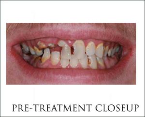 Pain Relief with Dental Implants