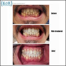 The KöR Tooth Whitening System