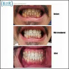 The KöR Tooth Whitening System
