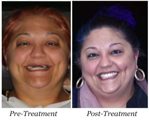 Before and After photo of female dental implant patient