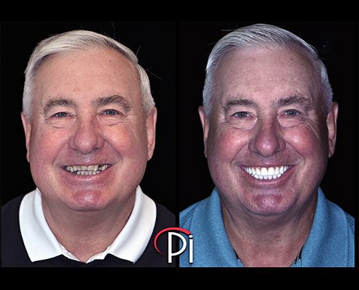 All-On-4 Treatment with AvaDent Pre-Treatment and Final Photos