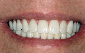 Dental Implant Treatment Photos: Every Woman Needs A Great Smile