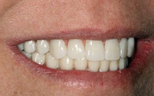 Dental Implant Treatment Photos: Left Side View of Smile