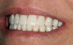 Dental Implant Treatment Photos: Right Side View of Smile