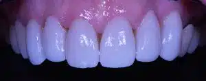 Closeup of Dental Veneers created at Pi Dental Center