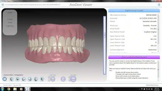 AvaDent prosthesis design in AvaDent Viewer