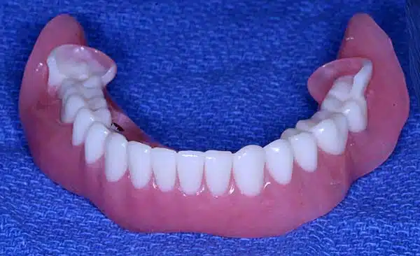 Photo of Occlusal Lock – When making dentures to be used in the Teeth In A Day® Process, it helps us to line up the teeth. It locks the teeth into position so that we can connect the removable teeth to the implants.