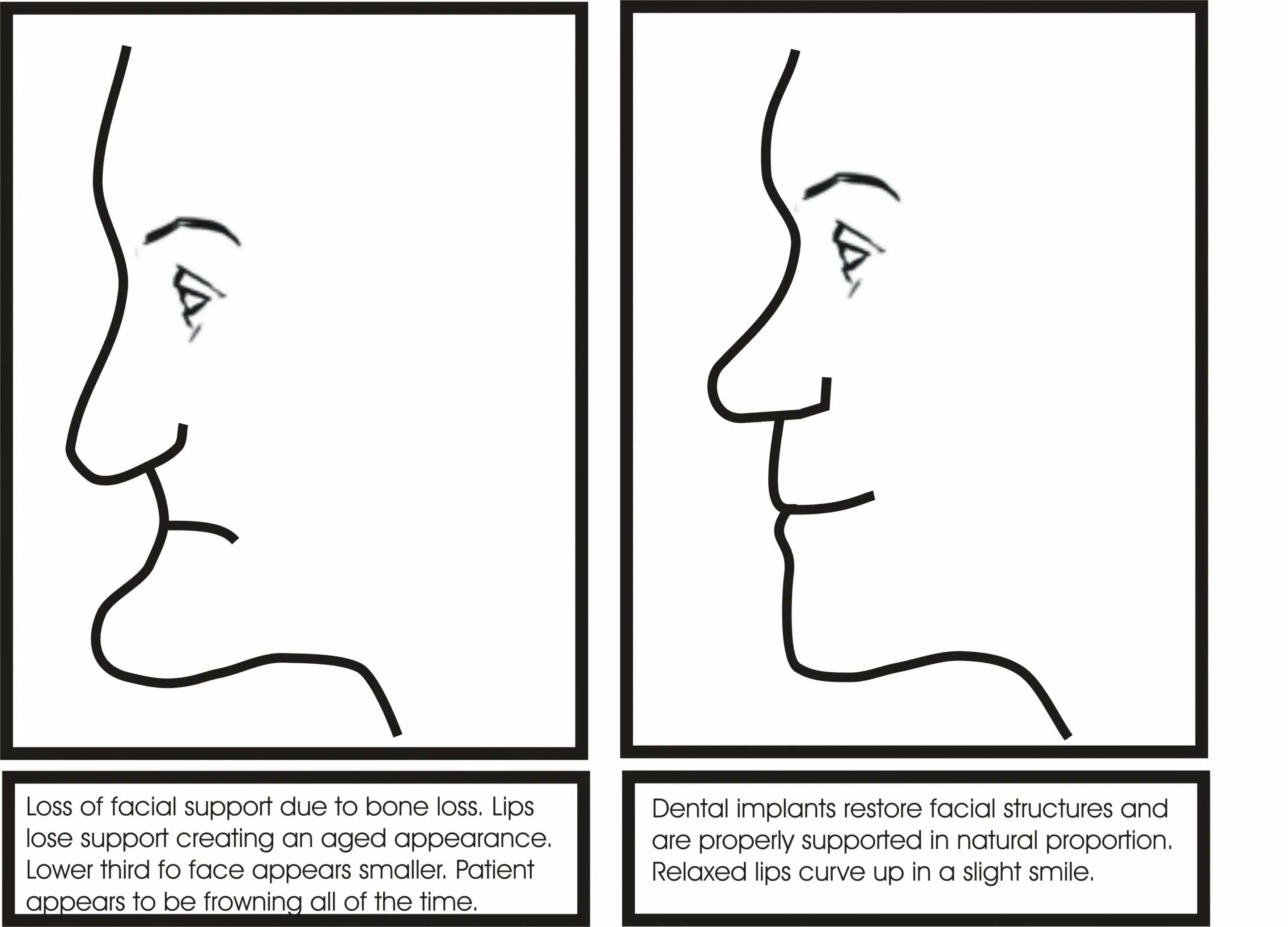 Illustration of facial collapse due to bone loss and restoration of facial proportion following dental implant treatment