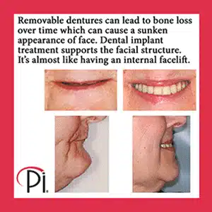 Dental implants support facial structure.