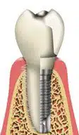Illustration of the similarities between a natural tooth and a dental implant