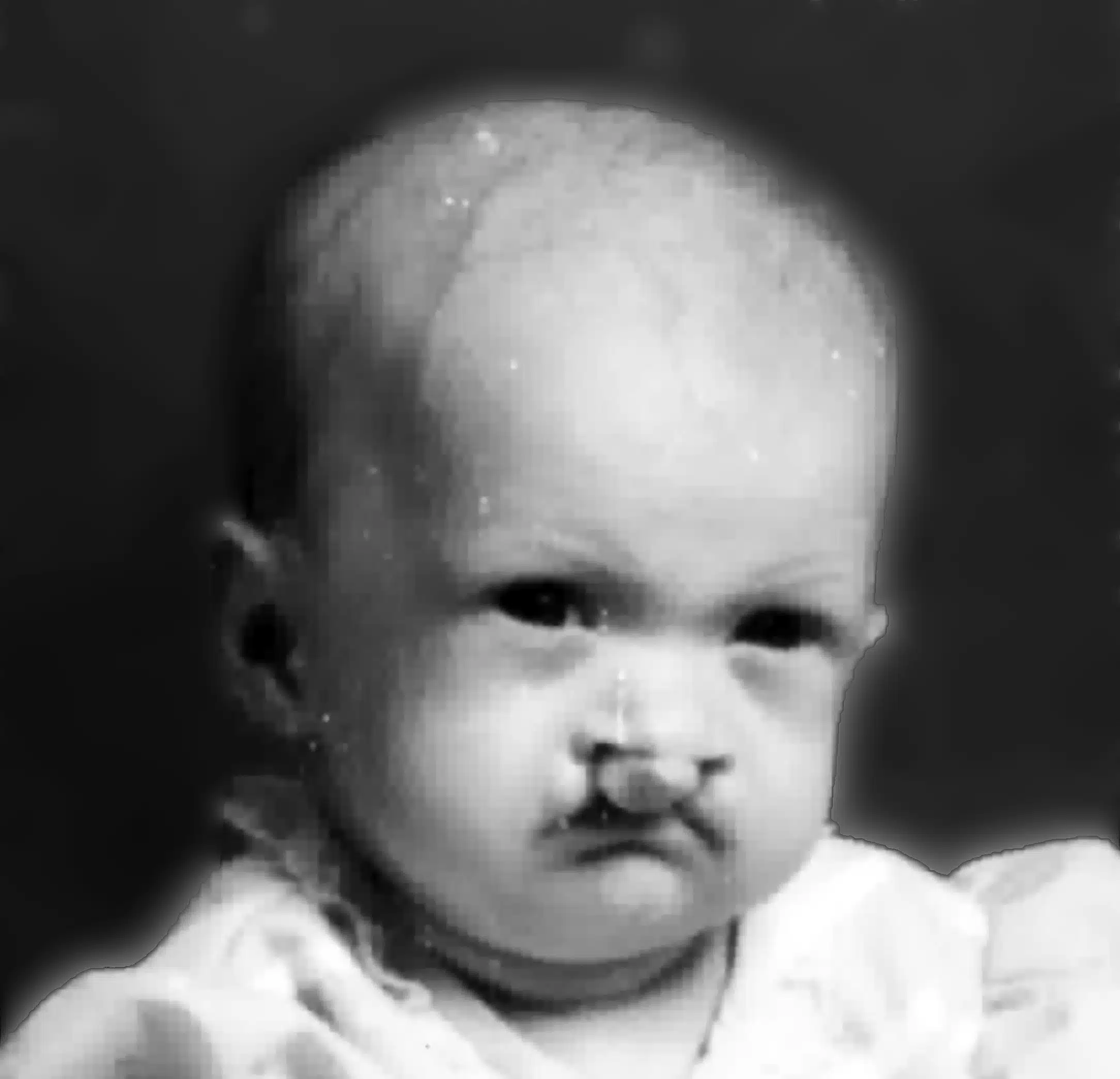 Infant with cleft lip and cleft palate