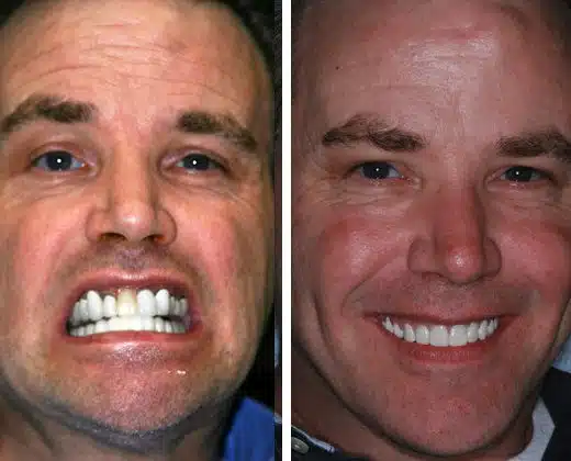 Ken before and after dental implant treatment with delivery of the Accelerset AvaDent Prosthesis