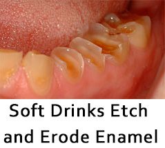 Photo illustrates how teeth can be eroded by soft drinks.