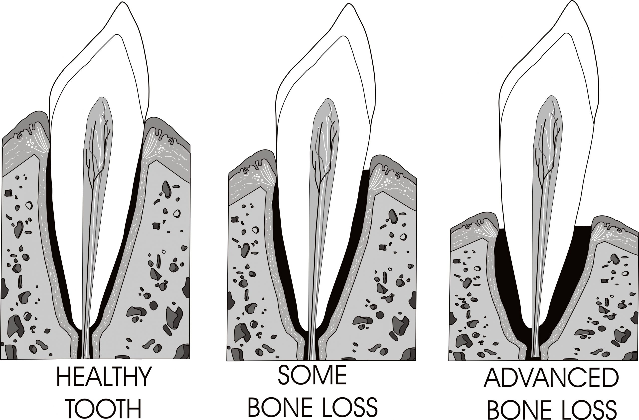Can this tooth be saved? Illustration of healthy tooth, tooth with some bone loss, tooth with advanced bone loss