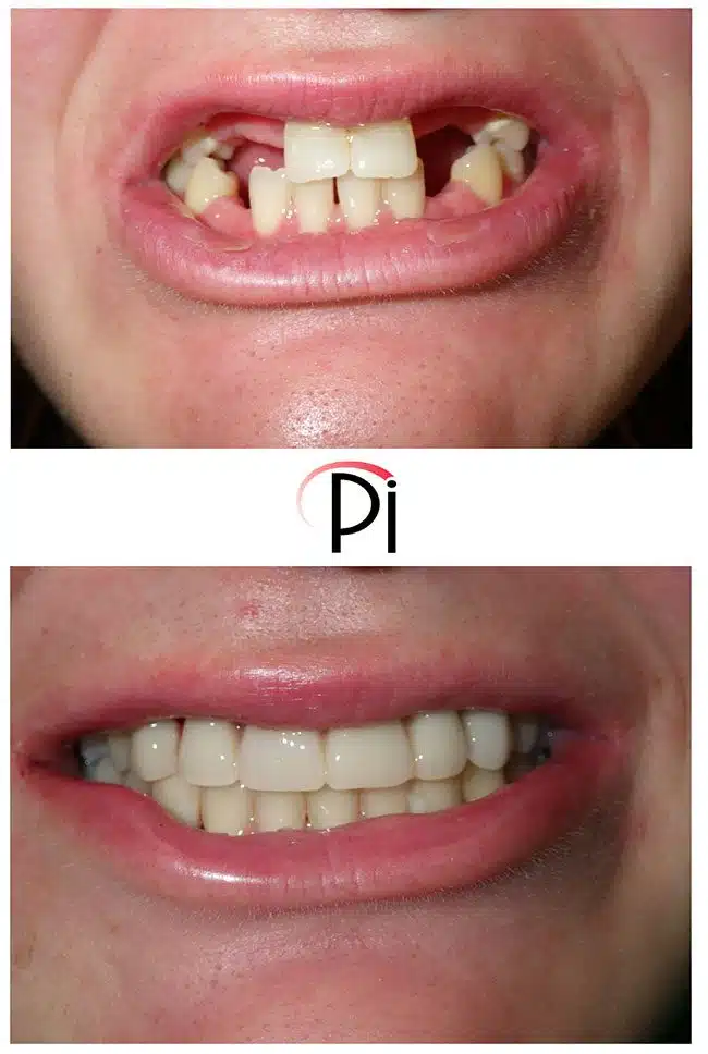 Before and After photo of Congenitally Missing Teeth with Implant Supported Crowns