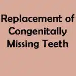 Replacement of Congenitally Missing Teeth