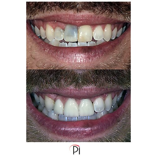 dental implants front teeth