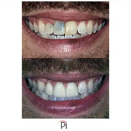 Dental Implants for Front Teeth