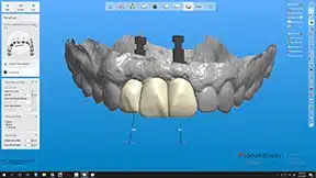 Dental Implant Supported Prosthesis Created at CM Prosthetics