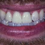 Patient photo: Dental implant treatment for the front teeth