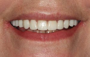 A beautiful new smile following guided dental implant placement.