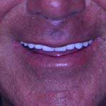 Patient Photo: Dental implant treatment for the upper teeth.
