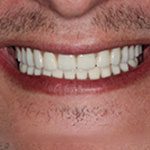 A beautiful smile with All-on-4 dental implant treatment