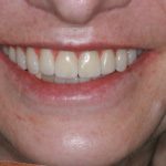 Upper Guided Dental Implant Surgery with Zygomatic Implants
