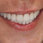 A Natural Smile with Dental Implants: Photos