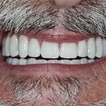Smile at Delivery of Final Dental Implant Supported Prosthesis