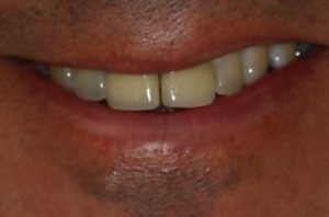Pre-treatment Photo of Upper Teeth Prior to Crown Treatment
