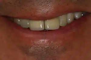 Pre-treatment Photo of Upper Teeth Prior to Crown Treatment