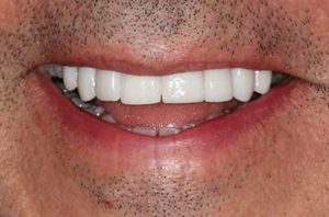 Post-Treatment Photo of Full-Contour Zirconia Crowns or Upper Teeth