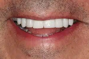 Post-Treatment Photo of Full-Contour Zirconia Crowns for Upper Teeth