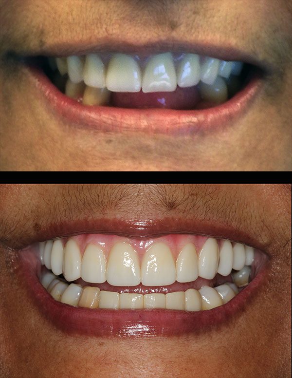 Before and after close-up image of patient with upper and lower dental implant treatment.