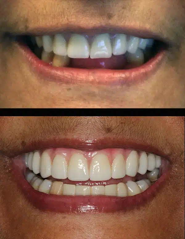 Before and after close-up image of patient with upper and lower dental implant treatment.