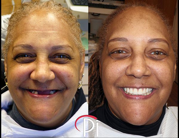 Before and after photos of a female dental implant patient.