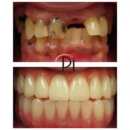 Pre-treatment and Post-Treatment Intraoral Photos of All-On-4 Female Patient