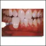 Tooth Whitening Images