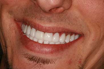 Upper and Lower Dental Implants