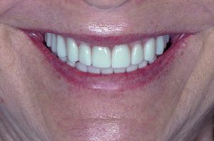 Post-treatment photo of dental implant patient