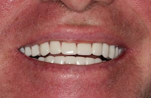 Post-treatment smile with All-On-4 Dental Implants in the lower arch and AvaDent upper