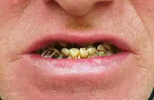 Pre-treatment mouth