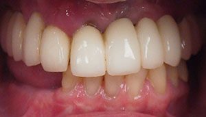Pre-Treatment Teeth Prior to All-On-4 Treatment