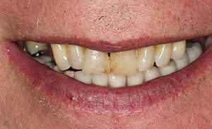 Pre-Treatment Photo of Teeth Before Dental Implant Restorations
