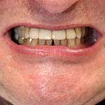 Single tooth implant supported restoration for a front tooth