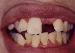 A patient's mouth prior to placement of a single tooth implant.