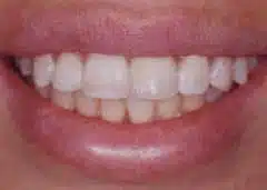 Post-treatment smile following placement of a single tooth implant and delivery of the final crown.