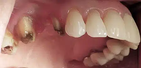 Area of mouth before placement of bridge